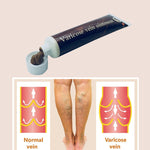 Varicose Veins Treatment Cream