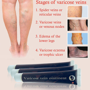 Varicose Veins Treatment Cream